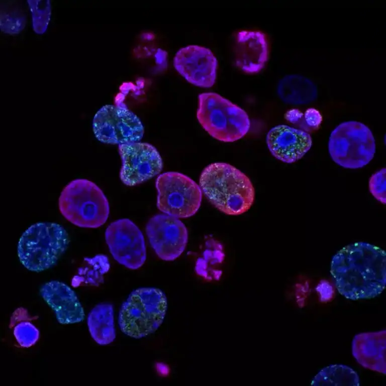 image of cancer cells causing pain that may be treated by ketamine