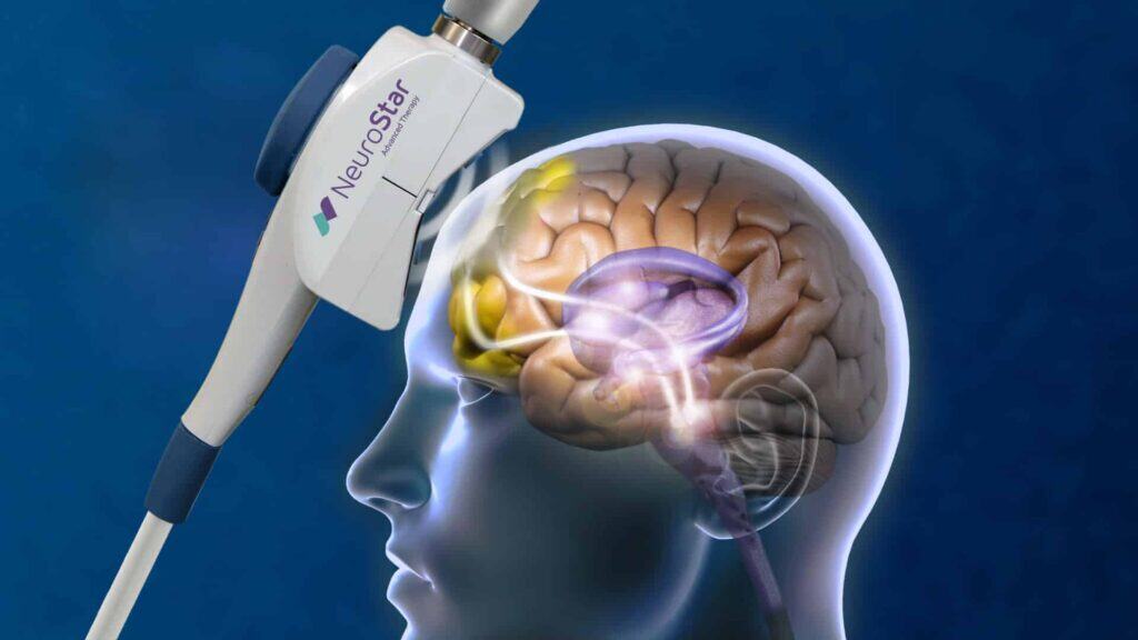 TMS Therapy on the brain